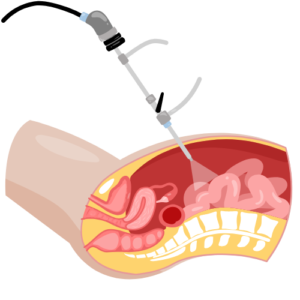 Gynae Surgery (Laparoscopy & Hysterectomy)